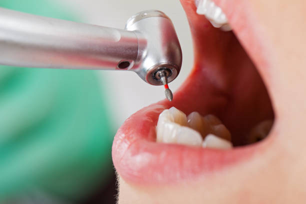 Best Emergency Treatment for Dental Infections or Abscesses in Maysville, GA